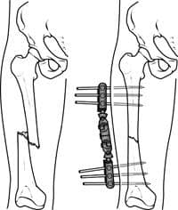 illustrated cross section of leg and broken human femur with external fixator