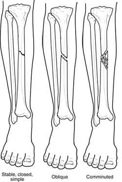 three illustrated cross sections of human leg showing different types of fractures