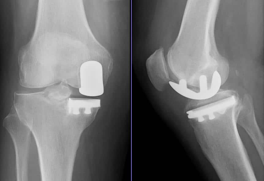 X ray partial knee replacement