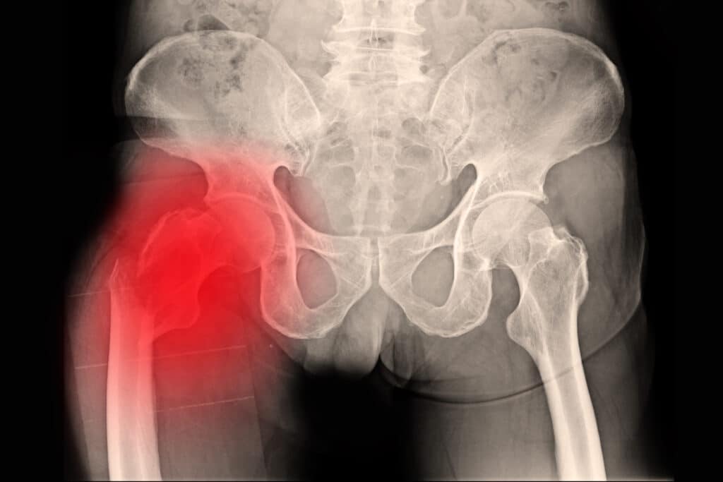 Signs of a Pelvic Fracture